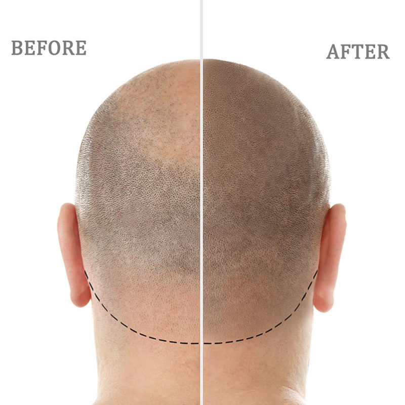 What is Scalp Micropigmentation? Baroque Beauty Center